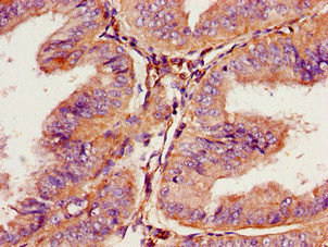 PROKR2/Prokineticin Receptor 2 Antibody - Immunohistochemistry image of paraffin-embedded human endometrial cancer at a dilution of 1:100