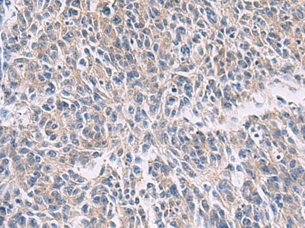PROKR2/Prokineticin Receptor 2 Antibody - Immunohistochemistry of paraffin-embedded Human colorectal cancer tissue  using PROKR2 Polyclonal Antibody at dilution of 1:40(×200)