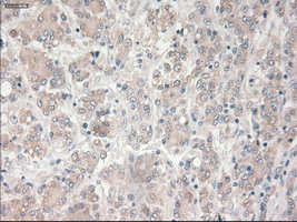Prominin 2 / PROM2 Antibody - Immunohistochemical staining of paraffin-embedded Carcinoma of liver tissue using anti-PROM2 mouse monoclonal antibody. (Dilution 1:50).