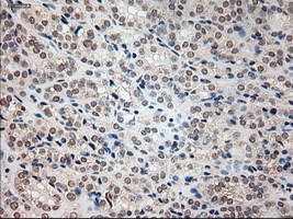 Prominin 2 / PROM2 Antibody - IHC of paraffin-embedded Carcinoma of thyroid tissue using anti-PROM2 mouse monoclonal antibody. (Dilution 1:50).