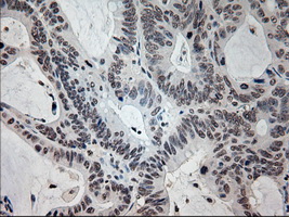 Prominin 2 / PROM2 Antibody - IHC of paraffin-embedded Adenocarcinoma of colon tissue using anti-PROM2 mouse monoclonal antibody. (Dilution 1:50).