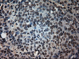 Prominin 2 / PROM2 Antibody - IHC of paraffin-embedded Adenocarcinoma of ovary tissue using anti-PROM2 mouse monoclonal antibody. (Dilution 1:50).