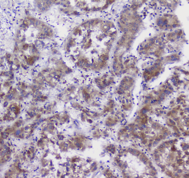 Properdin / CFP Antibody - IHC analysis of CFP using anti-CFP antibody. CFP was detected in paraffin-embedded section of human liver cancer tissue. Heat mediated antigen retrieval was performed in citrate buffer (pH6, epitope retrieval solution) for 20 mins. The tissue section was blocked with 10% goat serum. The tissue section was then incubated with 1µg/ml rabbit anti-CFP Antibody overnight at 4°C. Biotinylated goat anti-rabbit IgG was used as secondary antibody and incubated for 30 minutes at 37°C. The tissue section was developed using Strepavidin-Biotin-Complex (SABC) with DAB as the chromogen.