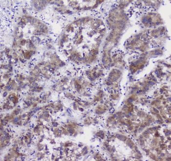 Properdin / CFP Antibody - IHC staining of FFPE human liver cancer with Properdin antibody at 1ug/ml. HIER: boil tissue sections in pH6, 10mM citrate buffer, for 10-20 min followed by cooling at RT for 20 min.