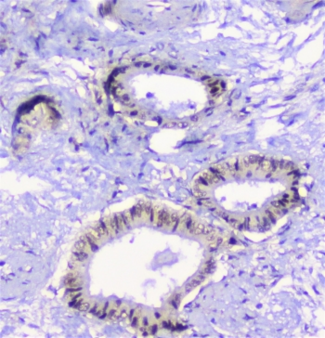 Properdin / CFP Antibody - IHC staining of FFPE human cholangiocarcinoma with Properdin antibody at 1ug/ml. HIER: boil tissue sections in pH6, 10mM citrate buffer, for 10-20 min followed by cooling at RT for 20 min.