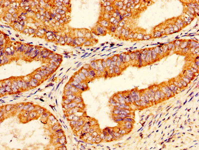 PROS1 / Protein S Antibody - IHC image of PROS1 Antibody diluted at 1:200 and staining in paraffin-embedded human endometrial cancer performed on a Leica BondTM system. After dewaxing and hydration, antigen retrieval was mediated by high pressure in a citrate buffer (pH 6.0). Section was blocked with 10% normal goat serum 30min at RT. Then primary antibody (1% BSA) was incubated at 4°C overnight. The primary is detected by a biotinylated secondary antibody and visualized using an HRP conjugated SP system.