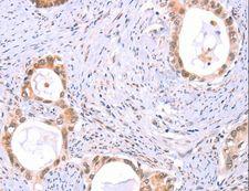 PROS1 / Protein S Antibody - Immunohistochemistry of paraffin-embedded Human thyroid cancer using PROS1 Polyclonal Antibody at dilution of 1:60.