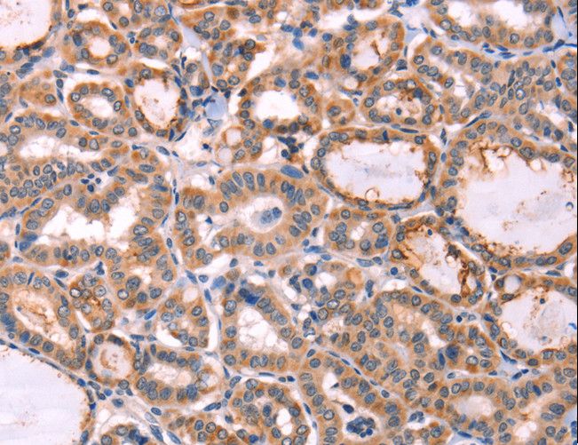 PROS1 / Protein S Antibody - Immunohistochemistry of paraffin-embedded Human thyroid cancer using PROS1 Polyclonal Antibody at dilution of 1:60.