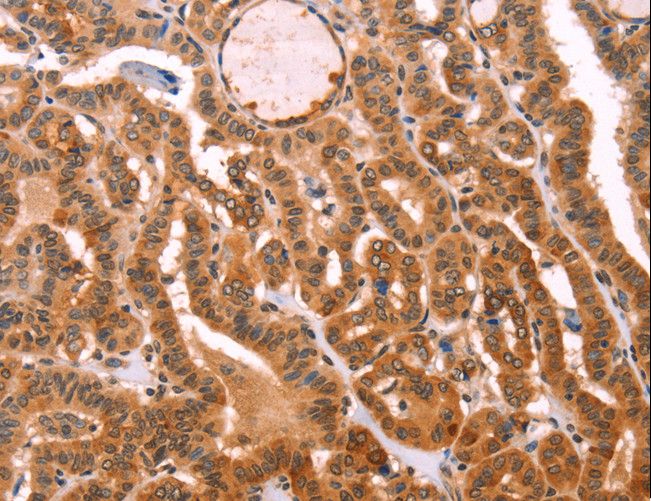 PROS1 / Protein S Antibody - Immunohistochemistry of paraffin-embedded Human lung cancer using PROS1 Polyclonal Antibody at dilution of 1:40.