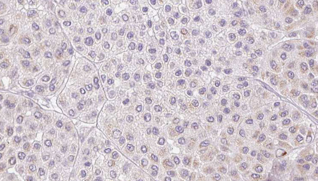 PROS1 / Protein S Antibody - 1:100 staining human Melanoma tissue by IHC-P. The sample was formaldehyde fixed and a heat mediated antigen retrieval step in citrate buffer was performed. The sample was then blocked and incubated with the antibody for 1.5 hours at 22°C. An HRP conjugated goat anti-rabbit antibody was used as the secondary.