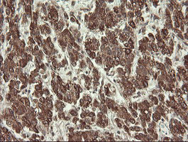 PROSC Antibody - IHC of paraffin-embedded Carcinoma of Human liver tissue using anti-PROSC mouse monoclonal antibody.