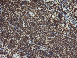 PROSC Antibody - IHC of paraffin-embedded Human lymphoma tissue using anti-PROSC mouse monoclonal antibody.