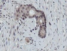 PROSC Antibody - IHC of paraffin-embedded Adenocarcinoma of Human colon tissue using anti-PROSC mouse monoclonal antibody. (Heat-induced epitope retrieval by 10mM citric buffer, pH6.0, 100C for 10min).
