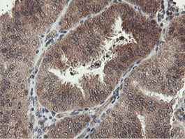 PROSC Antibody - IHC of paraffin-embedded Adenocarcinoma of Human endometrium tissue using anti-PROSC mouse monoclonal antibody. (Heat-induced epitope retrieval by 10mM citric buffer, pH6.0, 100C for 10min).