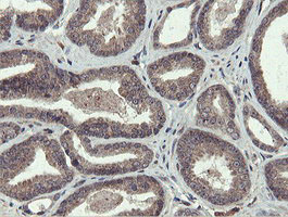 PROSC Antibody - IHC of paraffin-embedded Carcinoma of Human prostate tissue using anti-PROSC mouse monoclonal antibody. (Heat-induced epitope retrieval by 10mM citric buffer, pH6.0, 100C for 10min).