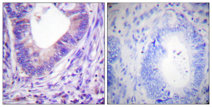 Protein Kinase A (PKA) Catalytic Subunit Antibody - Immunohistochemistry analysis of paraffin-embedded human colon carcinoma tissue, using PKA alpha/beta CAT Antibody. The picture on the right is blocked with the synthesized peptide.