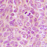 Protein Kinase A (PKA) Catalytic Subunit Antibody - Immunohistochemical analysis of PKA C alpha/beta/gamma (pT198) staining in human breast cancer formalin fixed paraffin embedded tissue section. The section was pre-treated using heat mediated antigen retrieval with sodium citrate buffer (pH 6.0). The section was then incubated with the antibody at room temperature and detected using an HRP conjugated compact polymer system. DAB was used as the chromogen. The section was then counterstained with hematoxylin and mounted with DPX.