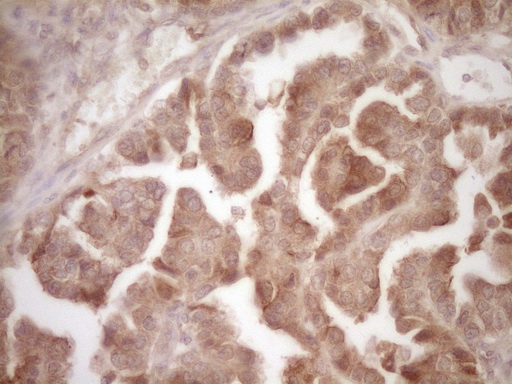 PROZ / Protein Z Antibody - Immunohistochemical staining of paraffin-embedded Adenocarcinoma of Human ovary tissue using anti-PROZ mouse monoclonal antibody. (Heat-induced epitope retrieval by 1 mM EDTA in 10mM Tris, pH8.5, 120C for 3min,