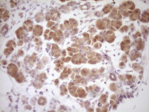 PROZ / Protein Z Antibody - Immunohistochemical staining of paraffin-embedded Carcinoma of Human pancreas tissue using anti-PROZ mouse monoclonal antibody. (Heat-induced epitope retrieval by 1 mM EDTA in 10mM Tris, pH8.5, 120C for 3min,
