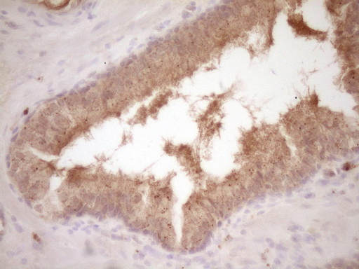 PROZ / Protein Z Antibody - Immunohistochemical staining of paraffin-embedded Adenocarcinoma of Human endometrium tissue using anti-PROZ mouse monoclonal antibody. (Heat-induced epitope retrieval by 1 mM EDTA in 10mM Tris, pH8.5, 120C for 3min,