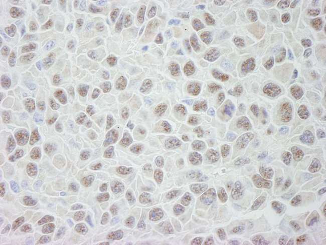 PRPF19 / PRP19 Antibody - Detection of Mouse PRP19/PSO4 by Immunohistochemistry. Sample: FFPE section of mouse squamous cell carcinoma. Antibody: Affinity purified rabbit anti-PRP19/PSO4 used at a dilution of 1:250.