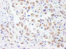 PRPF19 / PRP19 Antibody - Detection of Human PRP19/PSO4 by Immunohistochemistry. Sample: FFPE section of human metastatic lymph node. Antibody: Affinity purified rabbit anti-PRP19/PSO used at a dilution of 1:1000 (1 ug/ml). Detection: DAB.
