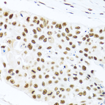 PRPF19 / PRP19 Antibody - Immunohistochemistry of paraffin-embedded human lung cancer using PRPF19 antibody at dilution of 1:100 (40x lens).