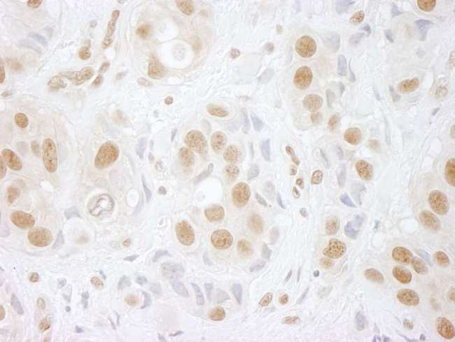 PRPF3 Antibody - Detection of Human hPrp3p Immunohistochemistry. Sample: FFPE section of human breast carcinoma. Antibody: Affinity purified rabbit anti-hPrp3p used at a dilution of 1:100.