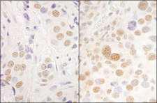 PRPF3 Antibody - Detection of Human and Mouse hPrp3p by Immunohistochemistry. Sample: FFPE section of human breast carcinoma (left) and mouse renal cell carcinoma (right). Antibody: Affinity purified rabbit anti-hPrp3p used at a dilution of 1:5000 (0.2and 1:1000 (1 Detection: DAB.