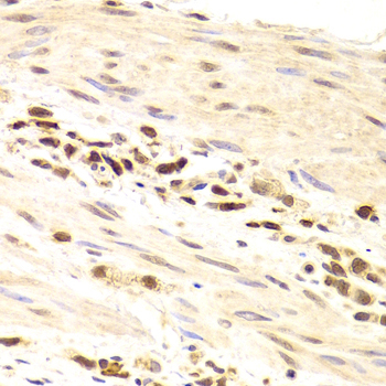 PRPF3 Antibody - Immunohistochemistry of paraffin-embedded Human gastric cancer tissue.