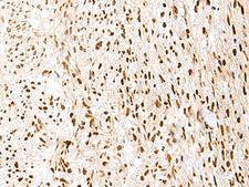 PRPF3 Antibody - Immunohistochemistry of paraffin-embedded Human liver cancer tissue  using PRPF3 Polyclonal Antibody at dilution of 1:35(×200)