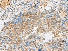 PRPF3 Antibody - Immunohistochemistry of paraffin-embedded Human cervical cancer tissue  using PRPF3 Polyclonal Antibody at dilution of 1:30(×200)