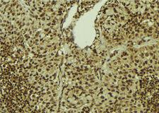 PRPF31 Antibody - 1:100 staining human breast carcinoma tissue by IHC-P. The sample was formaldehyde fixed and a heat mediated antigen retrieval step in citrate buffer was performed. The sample was then blocked and incubated with the antibody for 1.5 hours at 22°C. An HRP conjugated goat anti-rabbit antibody was used as the secondary.