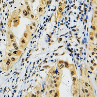 PRPF39 Antibody - Immunohistochemical analysis of PRPF39 staining in human lung cancer formalin fixed paraffin embedded tissue section. The section was pre-treated using heat mediated antigen retrieval with sodium citrate buffer (pH 6.0). The section was then incubated with the antibody at room temperature and detected with HRP and DAB as chromogen. The section was then counterstained with hematoxylin and mounted with DPX.