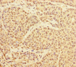 PRPF4 Antibody - Immunohistochemistry of paraffin-embedded human ovarian cancer at dilution of 1:100