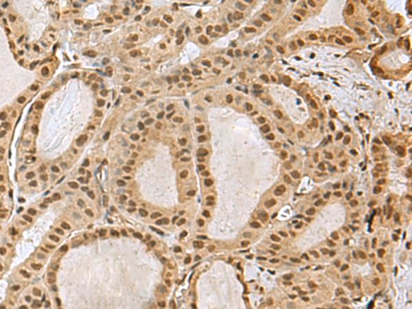 PRPF40A / FNBP3 Antibody - Immunohistochemistry of paraffin-embedded Human thyroid cancer tissue  using PRPF40A Polyclonal Antibody at dilution of 1:60(×200)