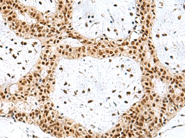 PRPF40A / FNBP3 Antibody - Immunohistochemistry of paraffin-embedded Human breast cancer tissue  using PRPF40A Polyclonal Antibody at dilution of 1:60(×200)