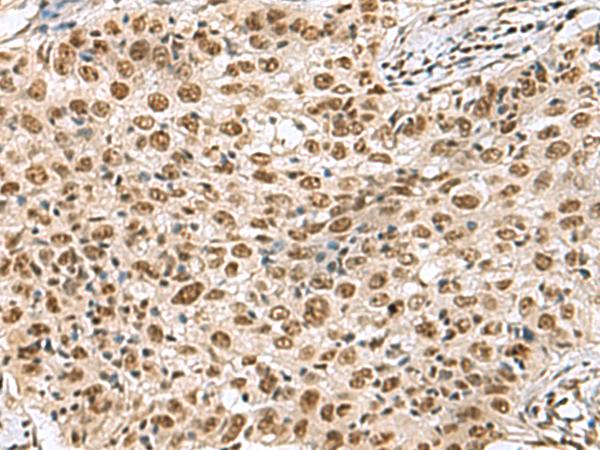 PRPF40A / FNBP3 Antibody - Immunohistochemistry of paraffin-embedded Human esophagus cancer tissue  using PRPF40A Polyclonal Antibody at dilution of 1:60(×200)