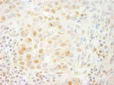 PRPF4B Antibody - Detection of Human PRPF4B by Immunohistochemistry. Sample: FFPE section of human breast carcinoma. Antibody: Affinity purified rabbit anti-PRPF4B used at a dilution of 1:200 (1 ug/ml). Detection: DAB.
