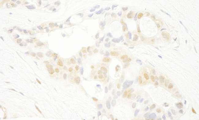 PRPF4B Antibody - Detection of Human PRPF4B by Immunohistochemistry. Sample: FFPE section of human ovarian carcinoma. Antibody: Affinity purified rabbit anti-PRPF4B used at a dilution of 1:250.