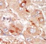 PRPF4B Antibody - Formalin-fixed and paraffin-embedded human cancer tissue reacted with the primary antibody, which was peroxidase-conjugated to the secondary antibody, followed by DAB staining. This data demonstrates the use of this antibody for immunohistochemistry; clinical relevance has not been evaluated. BC = breast carcinoma; HC = hepatocarcinoma.