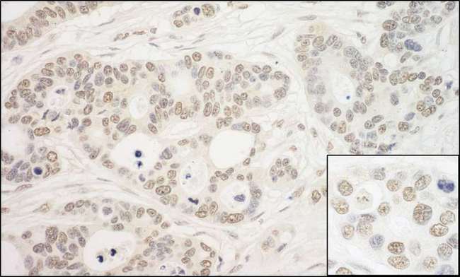 PRPF6 / TOM Antibody - Detection of Human PRP6 by Immunohistochemistry. Sample: FFPE section of human ovarian carcinoma. Antibody: Affinity purified rabbit anti-PRP6 used at a dilution of 1:200 (1 Detection: DAB.