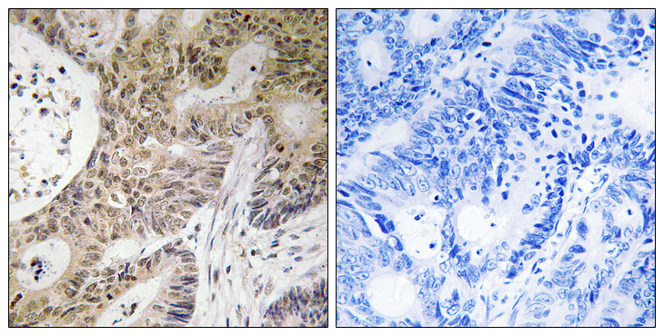 PRPF6 / TOM Antibody - Immunohistochemistry analysis of paraffin-embedded human colon carcinoma tissue, using PRPF6 Antibody. The picture on the right is blocked with the synthesized peptide.