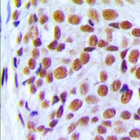 PRPF6 / TOM Antibody - Immunohistochemical analysis of PRPF6 staining in human breast cancer formalin fixed paraffin embedded tissue section. The section was pre-treated using heat mediated antigen retrieval with sodium citrate buffer (pH 6.0). The section was then incubated with the antibody at room temperature and detected using an HRP polymer system. DAB was used as the chromogen. The section was then counterstained with hematoxylin and mounted with DPX.