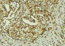 PRPF8 Antibody - 1:100 staining human breast carcinoma tissue by IHC-P. The sample was formaldehyde fixed and a heat mediated antigen retrieval step in citrate buffer was performed. The sample was then blocked and incubated with the antibody for 1.5 hours at 22°C. An HRP conjugated goat anti-rabbit antibody was used as the secondary.