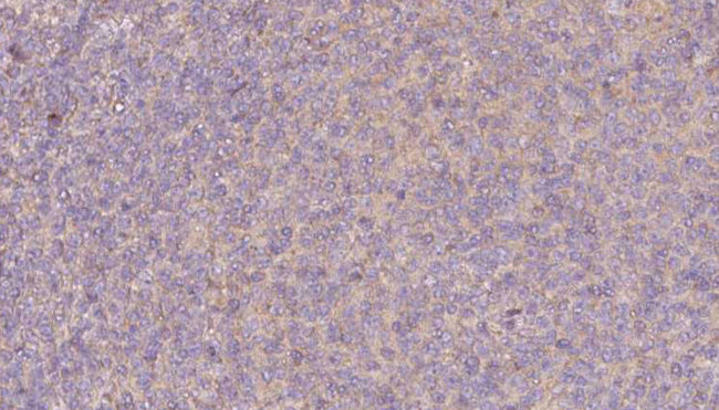 PRPH2 Antibody - 1:100 staining human lymph carcinoma tissue by IHC-P. The sample was formaldehyde fixed and a heat mediated antigen retrieval step in citrate buffer was performed. The sample was then blocked and incubated with the antibody for 1.5 hours at 22°C. An HRP conjugated goat anti-rabbit antibody was used as the secondary.