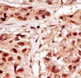 PRPK / TP53RK Antibody - Formalin-fixed and paraffin-embedded human cancer tissue reacted with the primary antibody, which was peroxidase-conjugated to the secondary antibody, followed by DAB staining. This data demonstrates the use of this antibody for immunohistochemistry; clinical relevance has not been evaluated. BC = breast carcinoma; HC = hepatocarcinoma.
