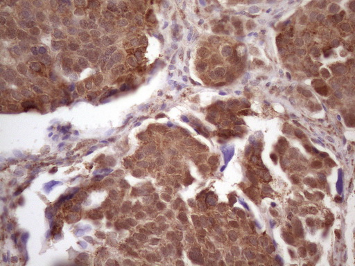 PRPK / TP53RK Antibody - IHC of paraffin-embedded Adenocarcinoma of Human ovary tissue using anti-TP53RK mouse monoclonal antibody. (Heat-induced epitope retrieval by 1 mM EDTA in 10mM Tris, pH8.5, 120°C for 3min)(1:150).