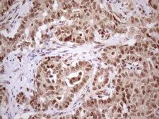PRPK / TP53RK Antibody - IHC of paraffin-embedded Carcinoma of Human liver tissue using anti-TP53RK mouse monoclonal antibody. (Heat-induced epitope retrieval by 1 mM EDTA in 10mM Tris, pH8.5, 120°C for 3min)(1:150).