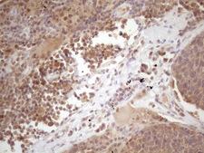 PRPK / TP53RK Antibody - Immunohistochemical staining of paraffin-embedded Carcinoma of Human lung tissue using anti-TP53RK mouse monoclonal antibody. (Heat-induced epitope retrieval by 1 mM EDTA in 10mM Tris, pH8.5, 120C for 3min. (1:150)